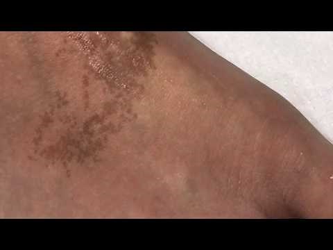 Nevus de Becker. Clínica Merced 👩‍⚕️👨‍⚕️