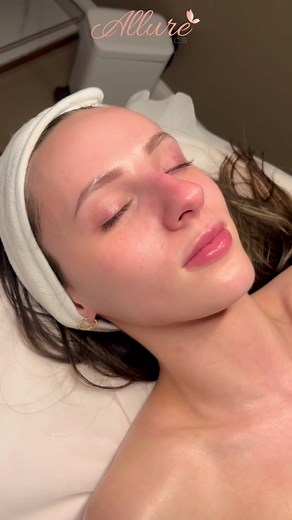 Allure Facials are bespoke, medical-grade treatments designed to target your specific skin concerns while delivering a luxury experience. Unlike standard spa facials, our treatments are performed by trained medical professionals using advanced skincare products and techniques to improve skin health, texture, and radiance. Instead of selecting from a menu, each facial is customized to your skin type, concerns, and goals for the best possible results. 📹 In this video, our client is receiving a ch
