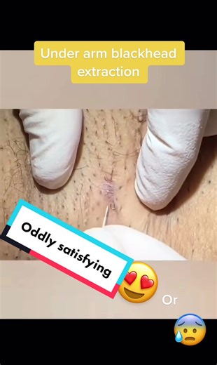 Under arm blackhead extraction by Insta: dr_josh_sar_siah #blackhead #extraction #pimplepopping #cyst #zit #acne #underarm