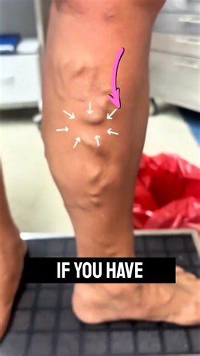 Fitness | Weight Loss | Back Pain | ✨ NATURAL VEIN CARE SECRET REVEALED! If you’re struggling with varicose veins, spider veins, or heavy/achy legs, this simple home remedy... | Instagram