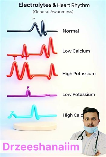 ECG|heart rhythm| arrhythmia |Normal rhythm |lowcalcium rhythm |high potassiumrhythm |#drzeeshanaiim