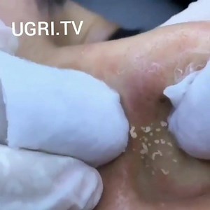 11K views · 42 reactions | Pimple Popper Tools: https://amzn.to/2K5BKZZ Thinergy for Weight Loss: https://amzn.to/2RVogD0 Blackhead Masks: https://amzn.to/2Si7az4 Lighted pick for earwax and tonsil stones: https://amzn.to/2m4lVYa #pimplepopping #acne #zits #blackheadremoval #cysticacne #cysts #dermatology #poppers #pimplepoppers #popaholics #drpimplepopper #drpopper #iheartautopsy #mediciyne #zit #comedones #dilatedpores #dilatedporeofwiner #comedoneextractorg | CystBursting.com | Facebook