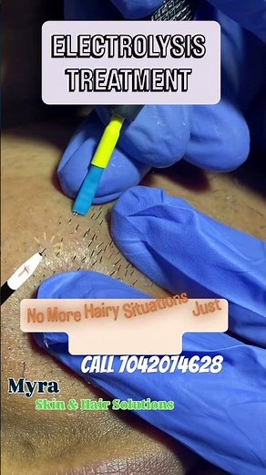 Permanent hair removal with electrolysis by Dr Sonia Mangal #electrolysis #facialhair #hairremoval