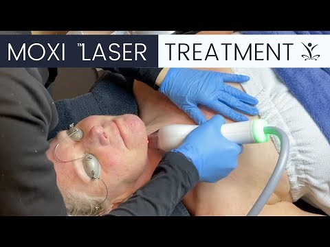 What is a Moxi Laser Treatment?