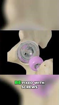 Hip Osteoarthritis: Total Hip Replacement Explained #shorts
