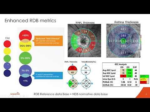 Introducing Optovue Solix by Visionix with Dr. Julie Rodman