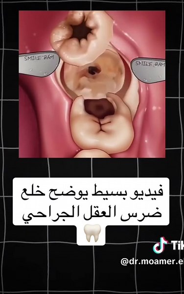 خلع ضرس العقل: خطوات ومعلومات مهمة