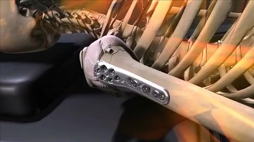 DePuy Synthes 骨科巨头的创伤解决方案