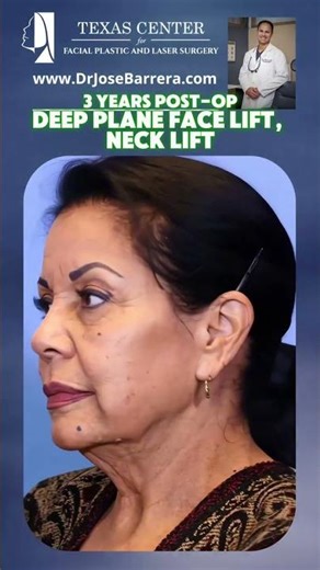 ✨ 3 Years Post-Op Deep Plane Facelift & Neck Lift Results ✨
