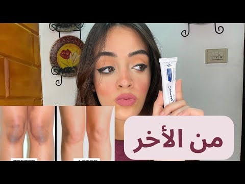 أسرع طريقة لتفتيح الركب و الأكواع بأقل من ٣٠ جنيه