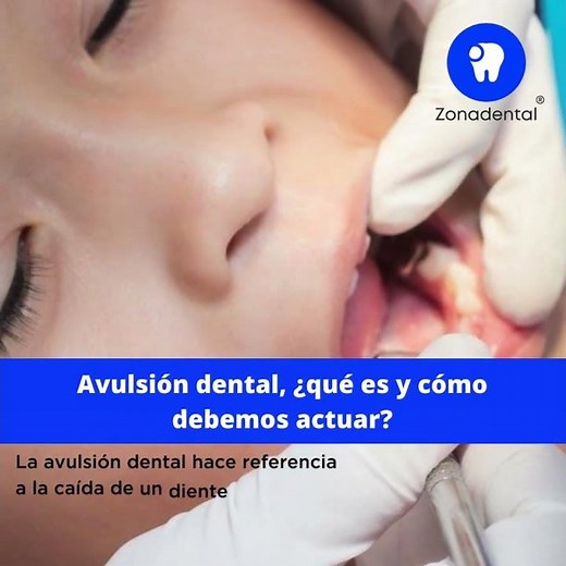 Avulsión dental, ¿qué es y cómo debemos actuar?