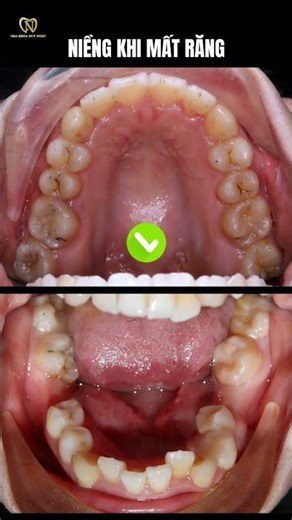 Niềng Răng Khi Mất Răng – Có Thể Thực Hiện Được Không?