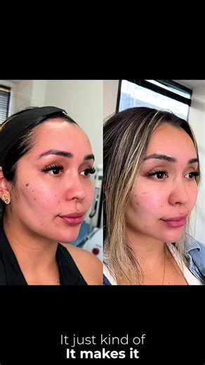 A Stunning Neurotoxin Transformation ✨ What if I told you that consistent neurotoxin treatments could do so much more than just soften fine lines? Let’s dive into this incredible transformation that proves how neurotoxin can truly enhance your face over time! Here’s what you’re seeing: ✔️ Volume Shift for a More Balanced Face her lower face carried more of the volume, which gave a heavier look. Through strategic use of neurotoxin over time, we helped “lift” and rebalance that volume, shifting it