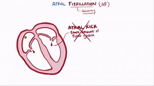 Atrial Fibrillation (AFib)