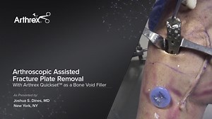 Arthroscopic Assisted Fracture Plate Removal With Arthrex® Quickset™ as a Bone Void Filler
