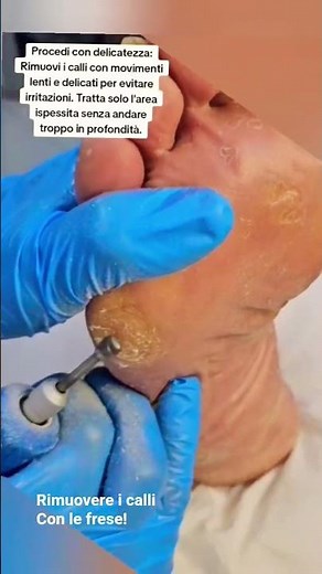 COME RIMUOVERE I CALLI CON LE FRESE. #pedicure #calli
