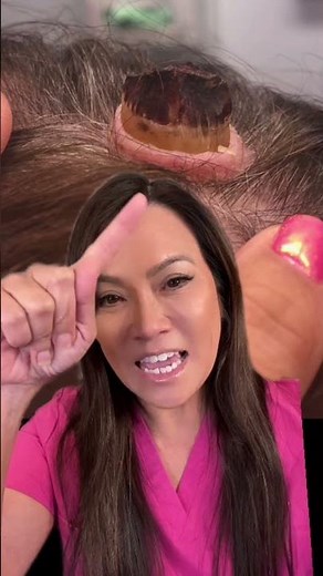 Please visit your dermatologist if you have cysts or lipomas - don't deal with it yourself!