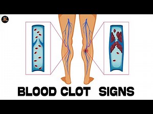 Warning Signs of a Blood Clot That Could Save Your Life | Don't Ignore These Symptoms!
