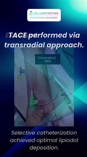 Transarterial Chemoembolization (TACE) for Hepatocellular Carcinoma.