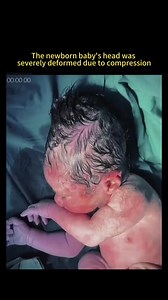 74K views · 310 reactions | Newborn baby's head was severely deformed due to compression  | We Love Babies | Facebook