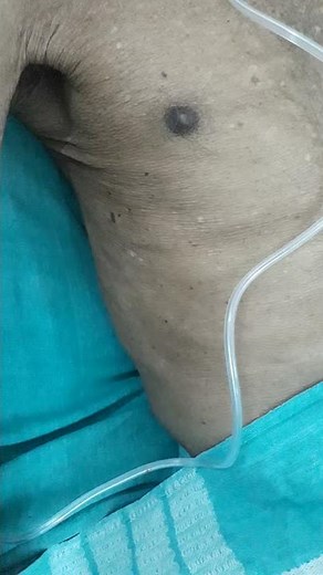 INDRAWING OF INTERCOSTAL MUSCLES Respiratory distress #emergency #medicine . Medical PANCH |MP.