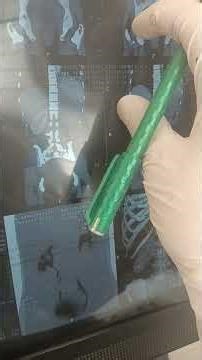 renal abscess and renal staghorn calculus