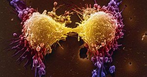 Cientistas descobrem gene por trás de câncer agressivo de próstata