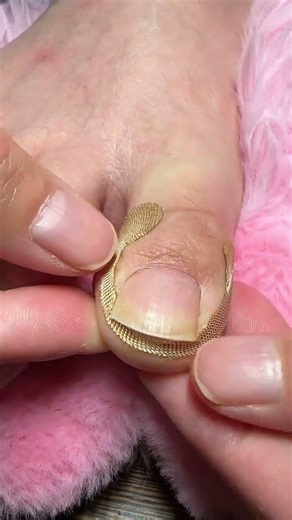 Ingrown Toenail Correction Foot Care Nail Treatment Shorts