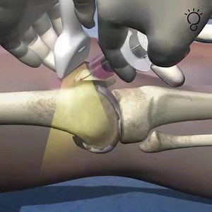 175K views · 1K reactions | Arthrose genou traitée par greffe de cellules souches de moelle osseuse | Biologie Université | Facebook