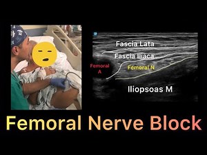 Femoral Nerve Block ( Ultrasound Guided)