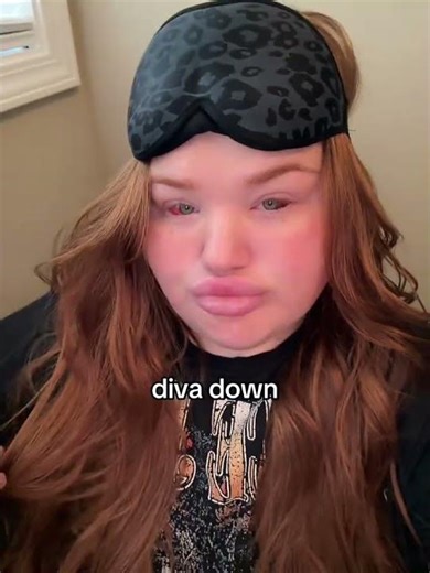 eye muscle surgery ftw #strabismus#fypOff Me - Bri3