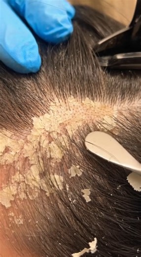 asmr dandruff removal using combing on head (48) | Showerer