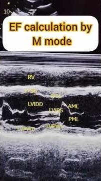 EF calculation by M Mode#LV measurements