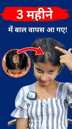11-Year-Old Girl's Alopecia Recovery 😳 | 3 Month Hair Regrowth Transformation