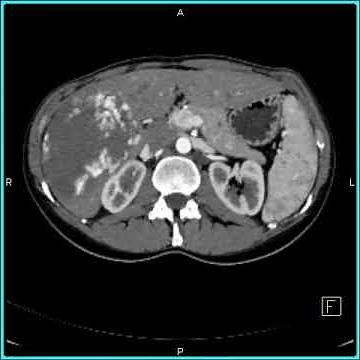 Abdomen: Liver: Cavernous Hemangioma of the Liver(1 of 9)