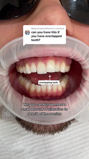 Replying to @jessxwilliamsx Dr Sunny completing this case without the use of braces and only a small amount of alteration to the front tooth which was overlapping. To avoid the alteration the patient would have had to have braces first which he did not want ✨