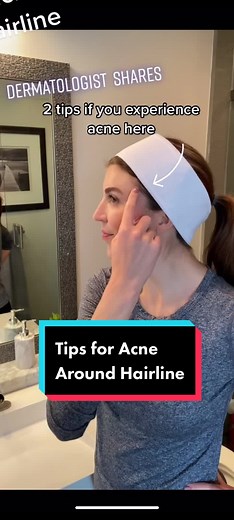 Tips to Prevent Acne Around Hairline
