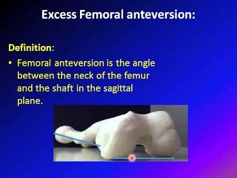 Intoeing - pigeon-toed