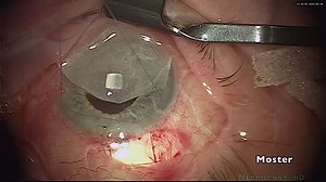 Fornix Based Trabeculectomy with MMC - Eyetube