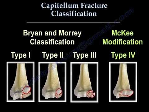 Capitellum Fracture Classification - Everything You Need To Know - Dr. Nabil Ebraheim
