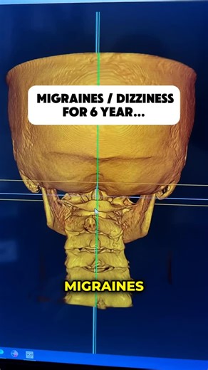 Dr. Preston Gregory on Instagram: "Migraines and Dizziness that never seems to go away… plus a constant pain, pressure or tightness at the base of your skull indicates your neurological symptoms could be linked to your upper neck. Comment YES below for more info on how we can help you. #reels #migraine #dizziness #vertigo #explore"