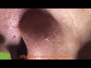 What's That Crater?; Acne Removal 26; (Full Screen) Super Big Pops