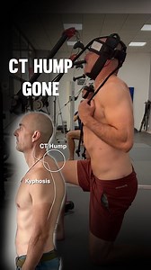 When you see a cervical-thoracic junction hump forming, it’s not just a posture flaw. It’s a sign that the body doesn’t have enough space or balanced tension to support the head and ribcage correctly. These humps rarely go away on their own because to re-fit that area of the spine, you need to create a global redistribution of tension throughout the entire body. You have to create just enough space everywhere else, ribcage, pelvis, spine, glutes, even down into the feet so that the CT region has