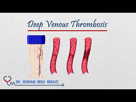 DVT Deep Venous Thrombosis (Pathophysiology - Risk Factors - Presentation - Diagnosis - Management)