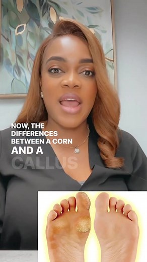 Understanding the Difference Between Corn and Callus