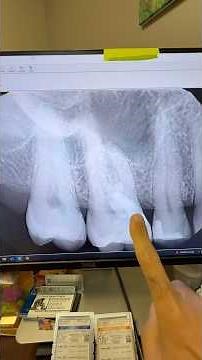 Cervical inflammatory resorption. #dentists #dentalartistry #hygienist #dentaltreatment #rootcanal