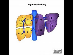 Hepatectomy or Liver resection Surgical Procedure; introduction, Indications, Procedure, Types, Uses