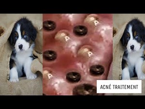 Extraction point noir, acné, kyste en profondeur #24