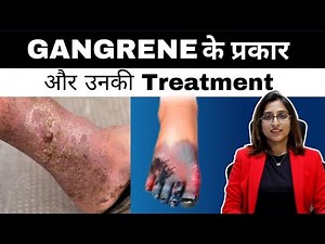 Types and Treatments of Gangrene | Explained by Dr. Kaurabhi Zade, Interventional Radiologist
