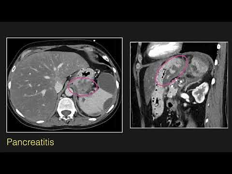 Abdominal Radiology Lecture: CT of Esophageal and Gastric Pathology